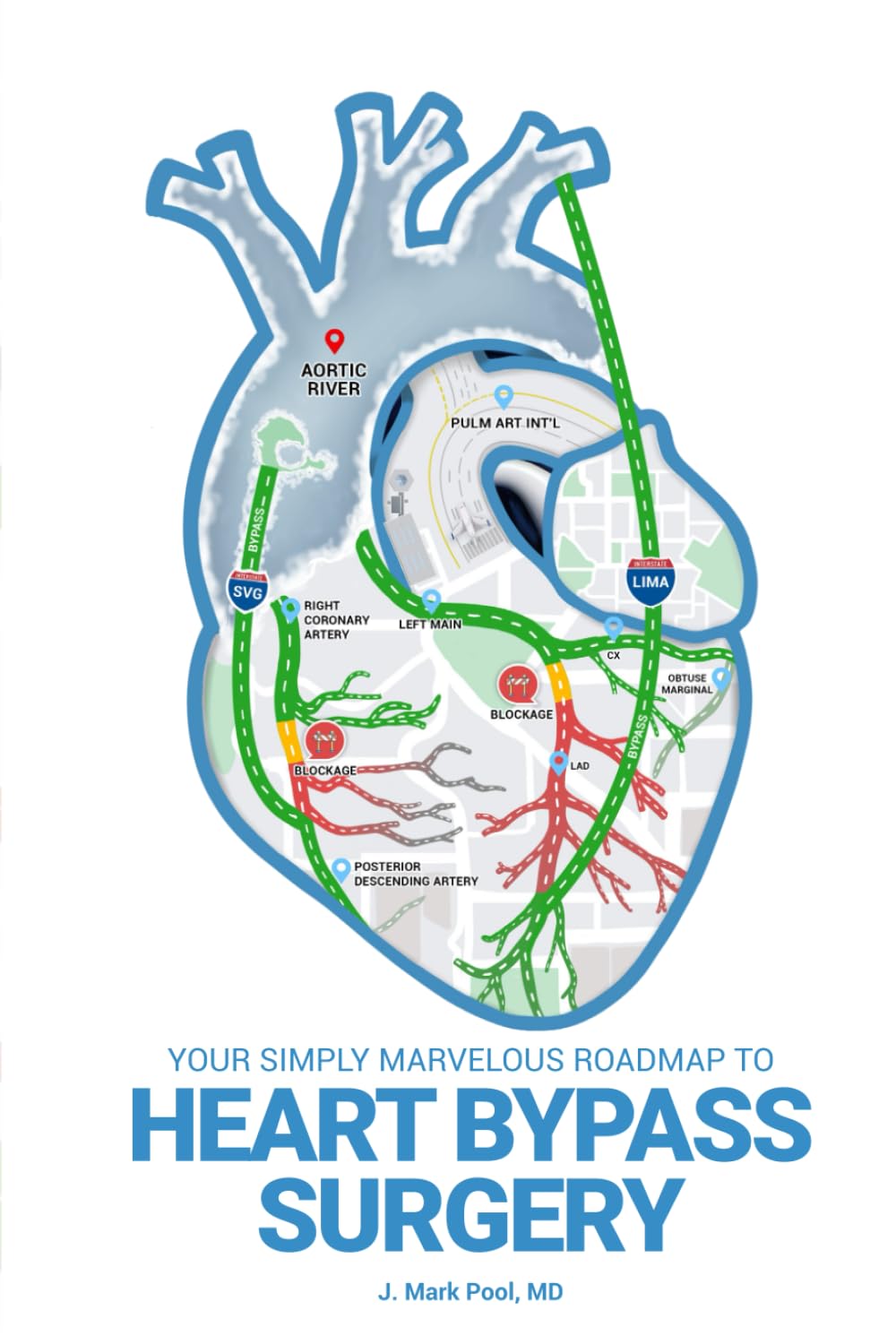 Your Simply Marvelous Roadmap to Heart Bypass Surgery