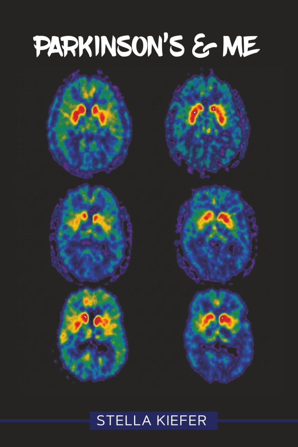 Parkinson’s and Me: How to Overcome the Shock After Diagnosis