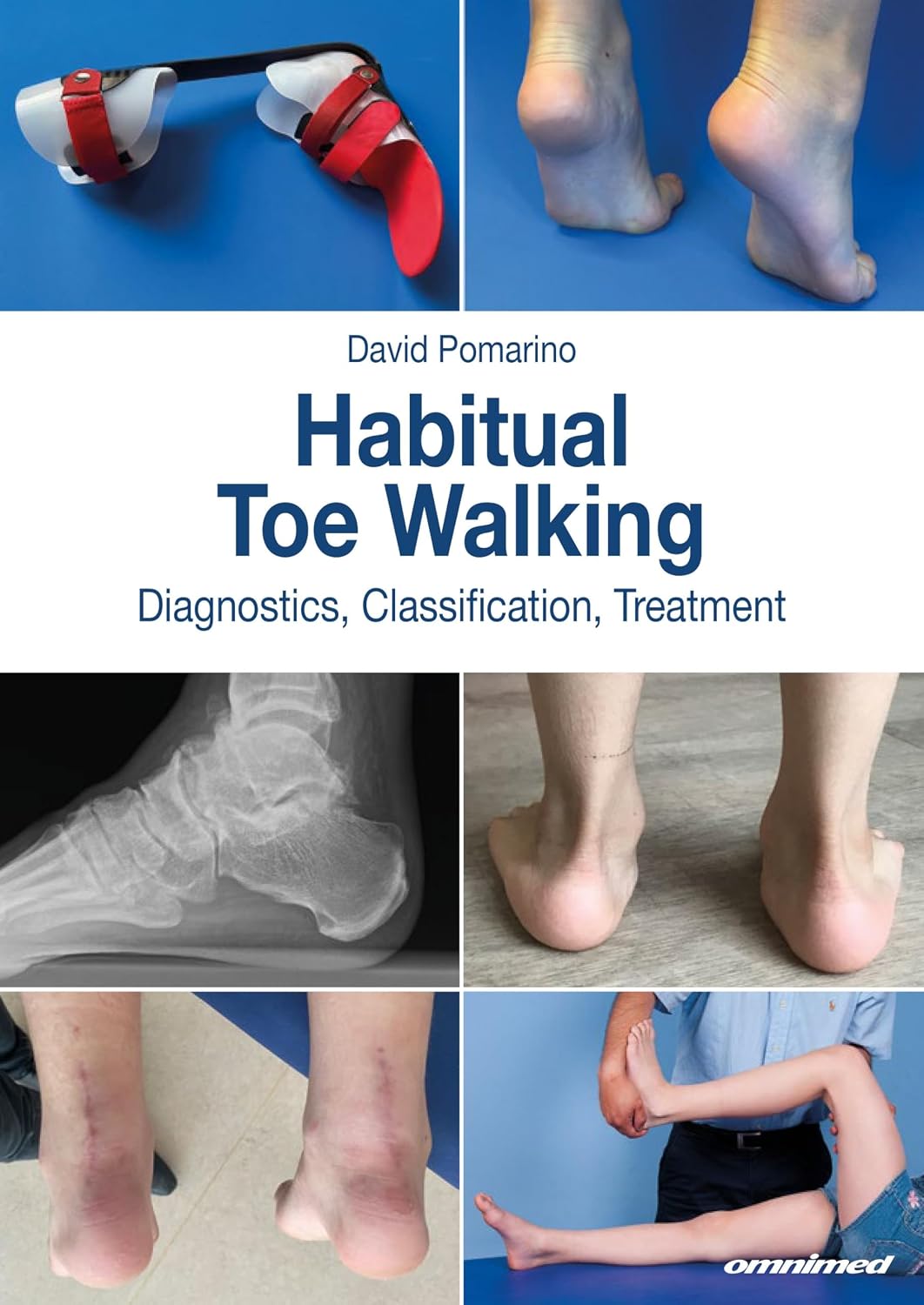 Habitual Toe Walking: Diagnostics, Classification, Treatment