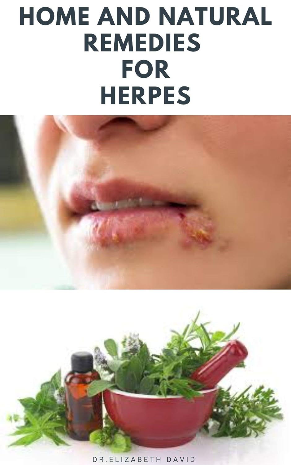 HOME AND NATURAL REMEDIES FOR HERPES
