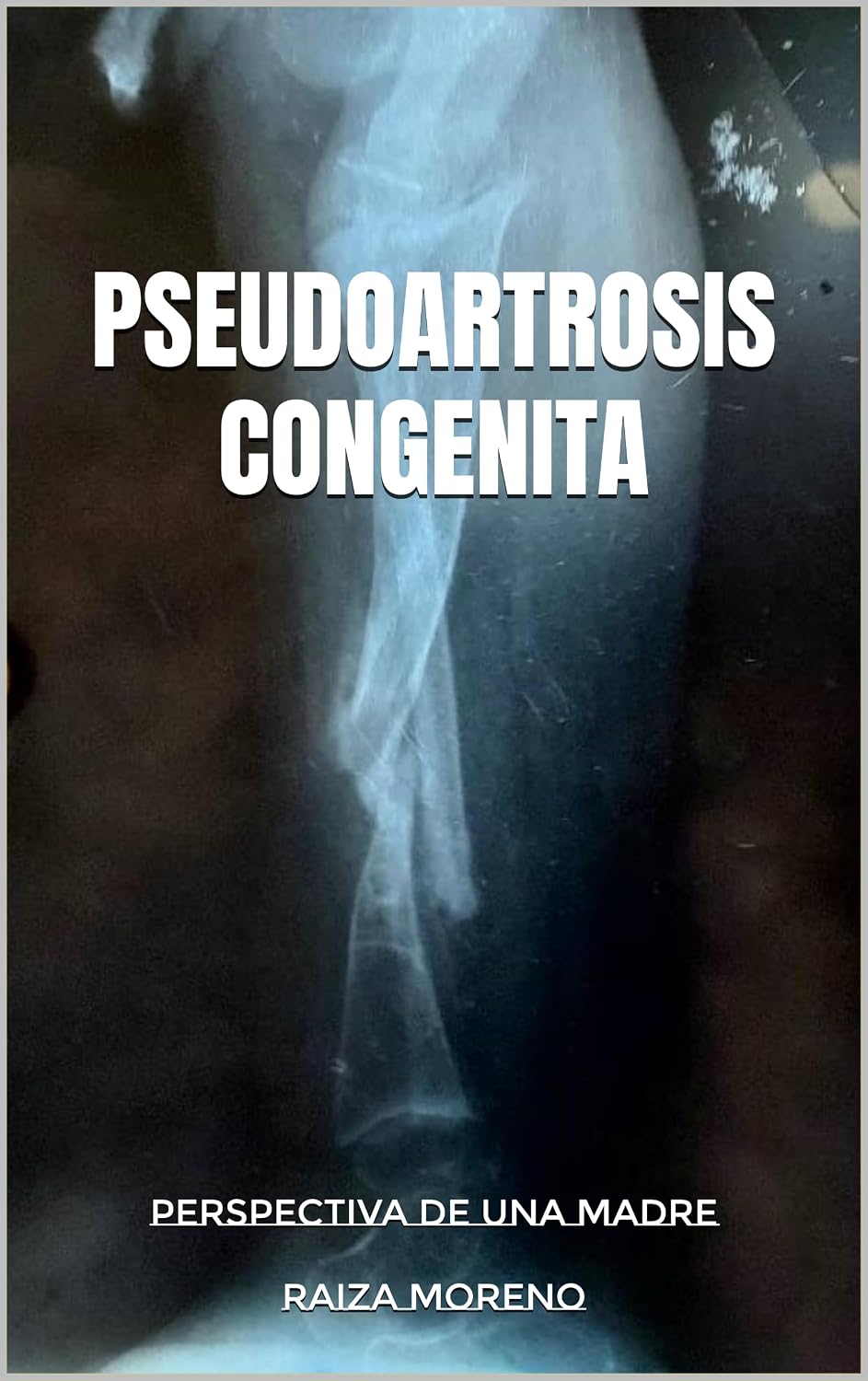 Pseudoartrosis congenita: Perspectiva de una madre (Spanish Edition)