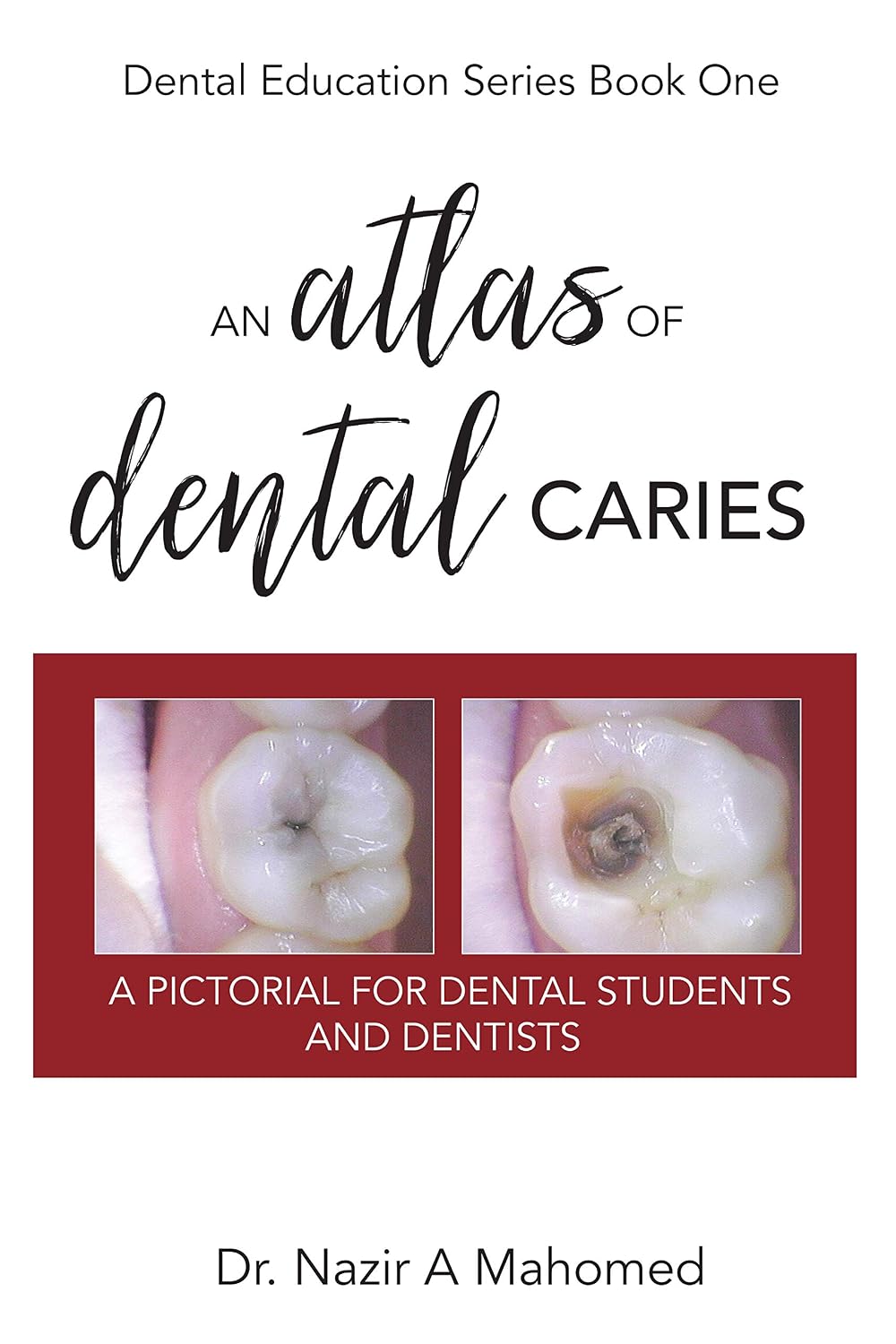An Atlas of Dental Caries: A Pictorial For Dental Students and Dentists