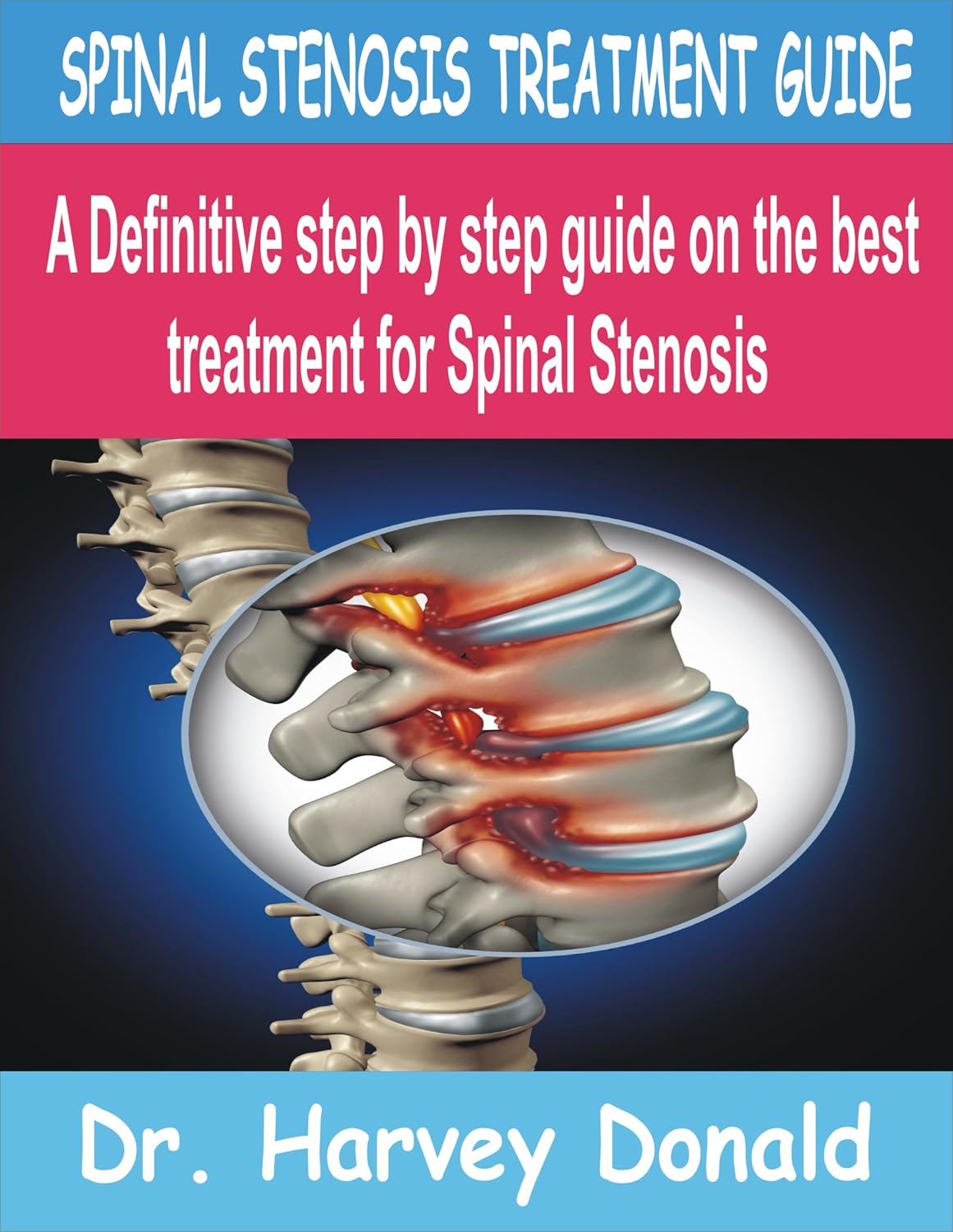 SPINAL STENOSIS TREATMENT GUIDE: A Definitive step by step guide on the best treatment for Spinal Stenosis