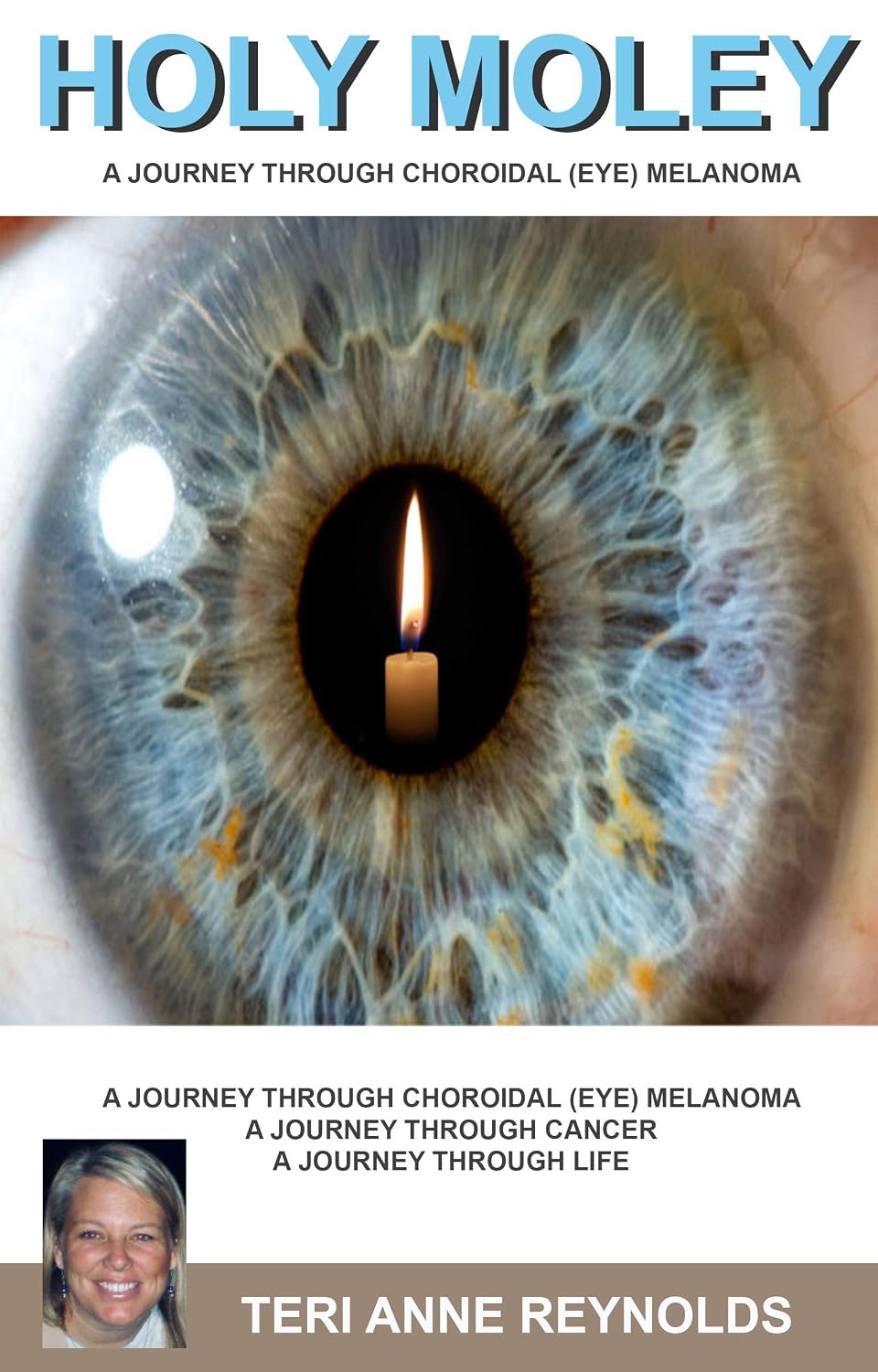 Holy Moley: A Journey Through Choroidal (Eye) Melanoma